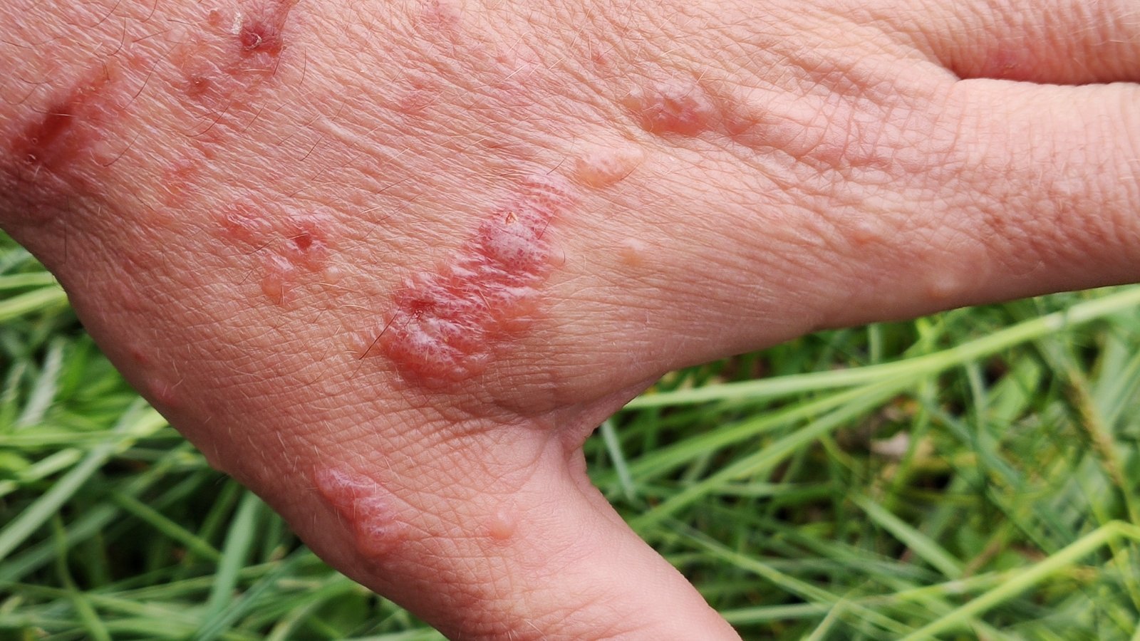 A close-up of an arm showing a patch of red, irritated skin, with visible blisters and inflammation caused by contact with Pastinaca sativa or similar toxic plants. The background of green grass hints at outdoor exposure, with the irritated area displaying symptoms of phytophotodermatitis.